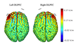 Transcranial Direct Current Stimulation Modulates Dysexecutive Deficits and its Neurophysiological Signatures in Attention-Deficit Hyperactivity Disorder